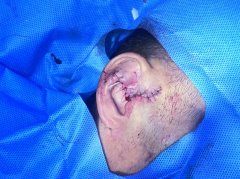 送货员意外割断耳朵，医生妙手缝补恢复如初